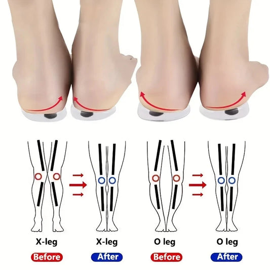 Orthopedic Insoles for Feet O/X Leg Type Valgus Correction Men Women